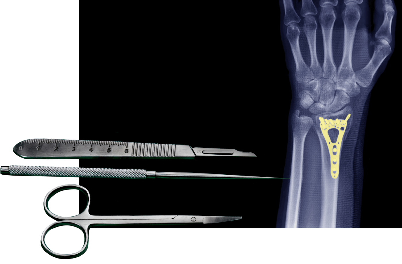 Medical instruments and an Xray of a machined part inside of an arm.